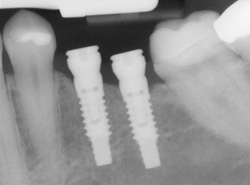 How a dental implant looks on an x-ray